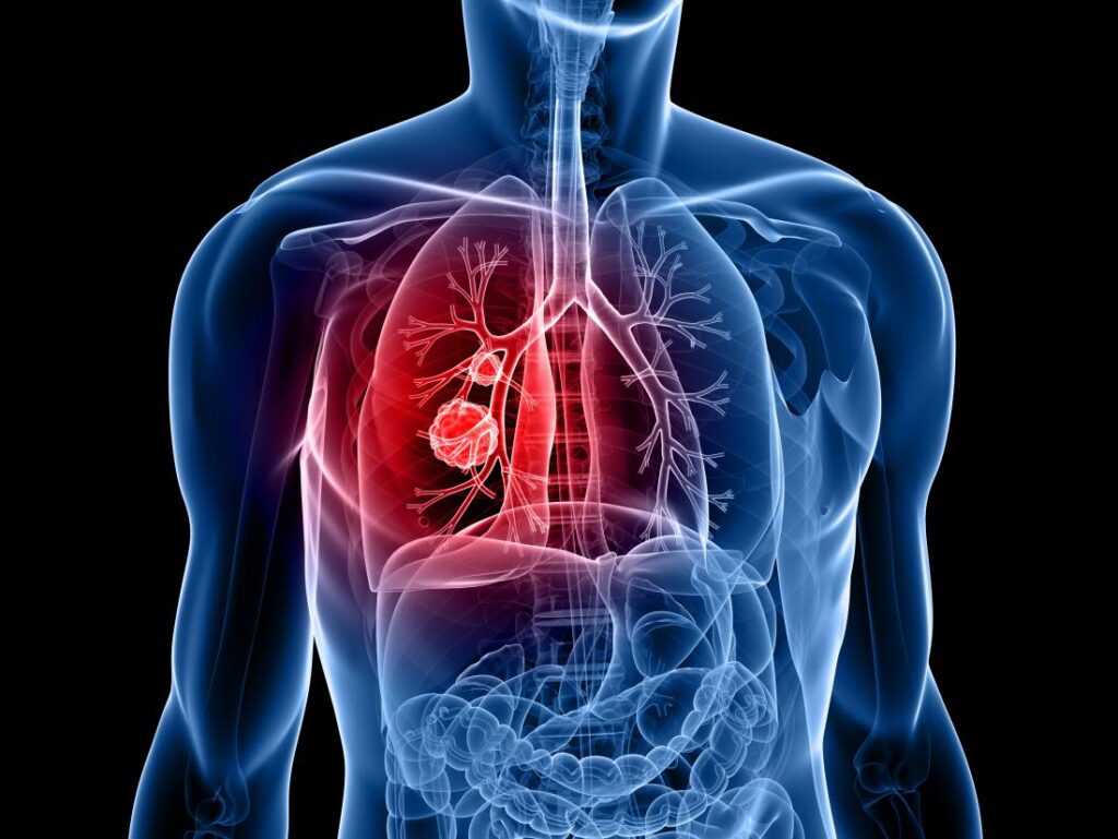 lung cancer 2 Healthcare