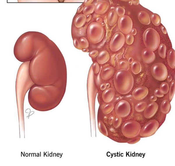 21846 cystic kidney disease 2 Healthcare