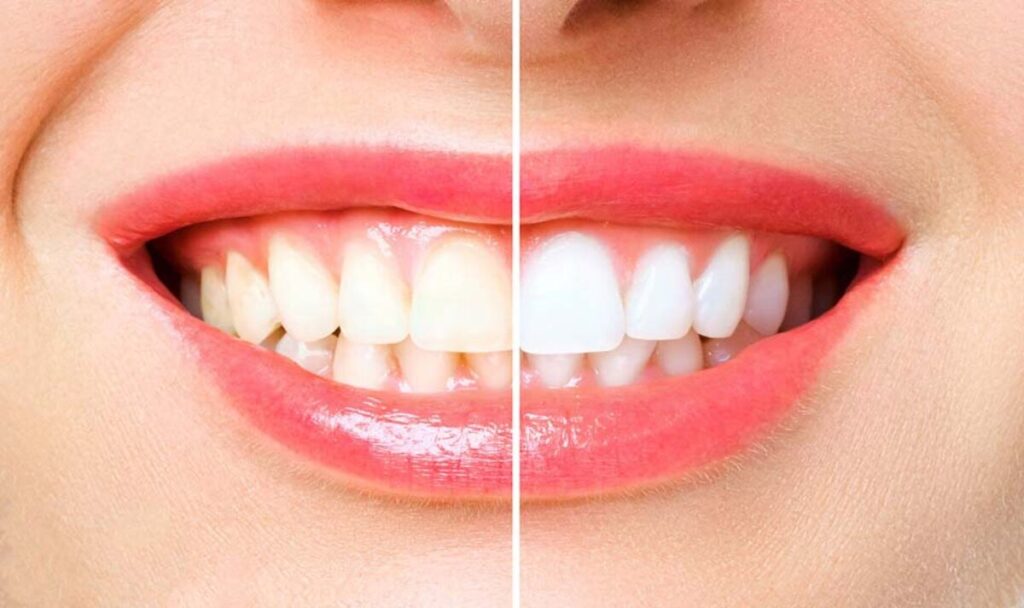 Teeth Whitening Remedies At Home 1200x712 3 Healthcare