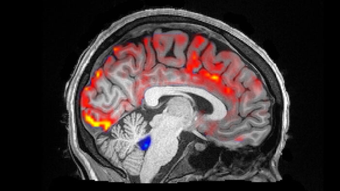 brain detox sleep dementia risk